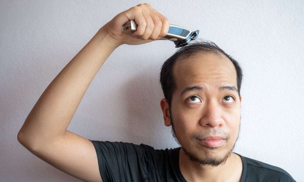 Oily hair, hair loss, and baldness that occur in men 