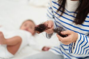 New mothers face postpartum hair loss.