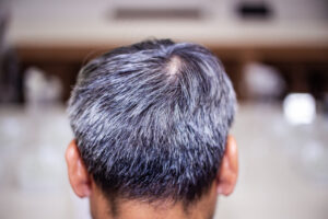 Men’s graying hair problem