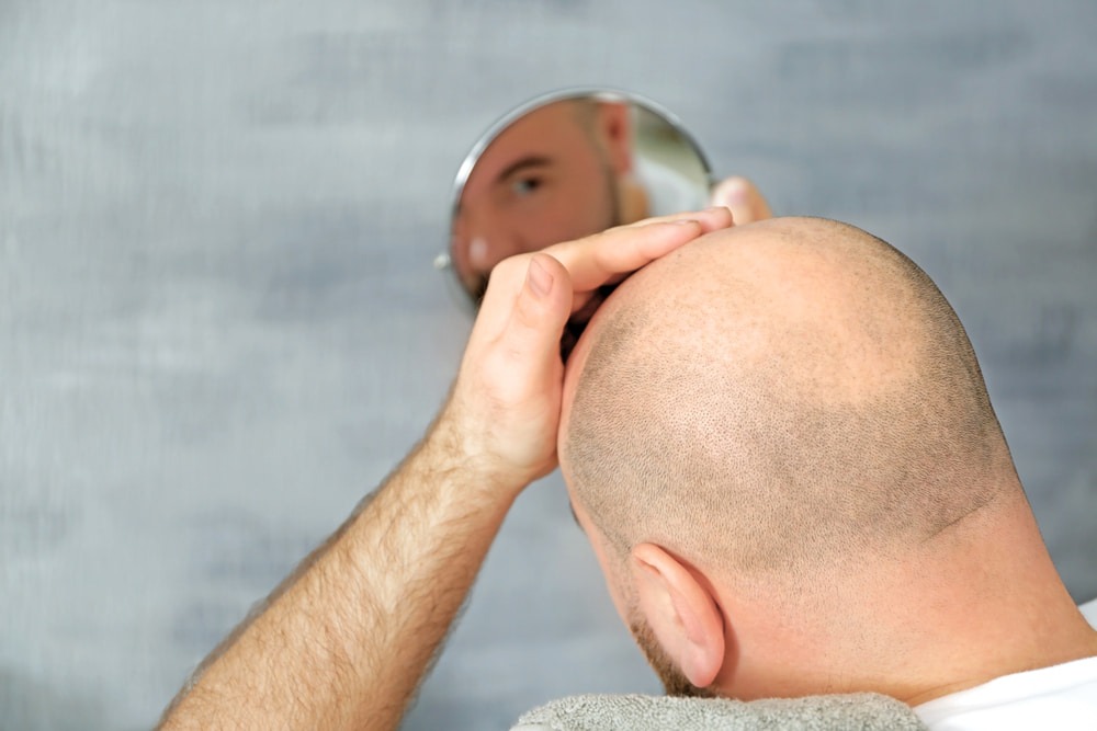 Men who are worried about baldness and want to have FUE hair transplants