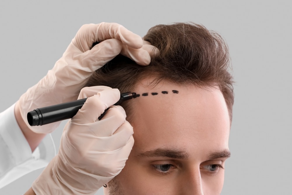 Men with thinning hair undergo FUE hair transplant surgery