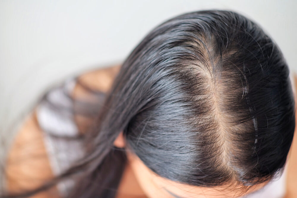 Women with hair thinning problem