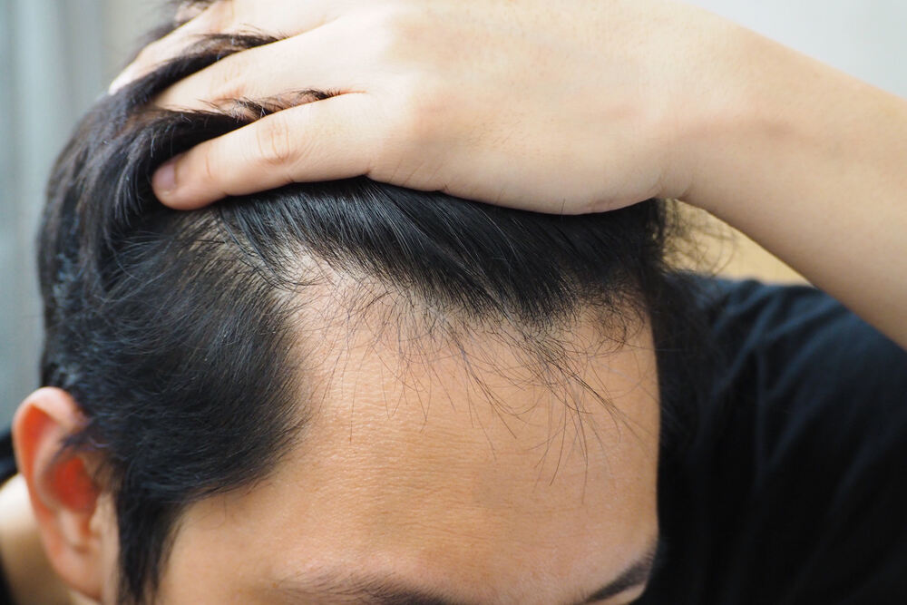 When there’s a hair thinning problem, hair growth medication is usually the first option.